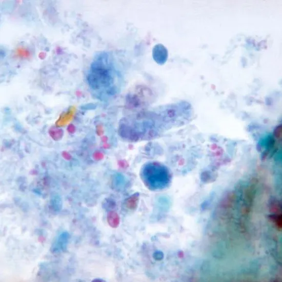 Dientamoeba Fragilis : The Foremost Common Intestinal Protozoan